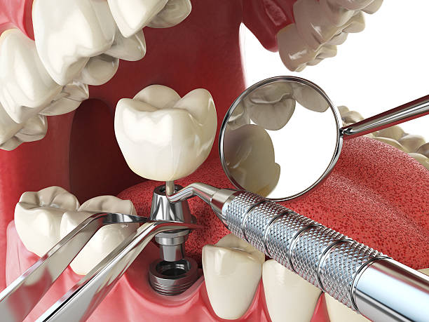 Best Emergency Root Canal Treatment in Huntington Woods, MI